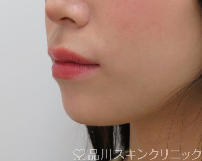 症例NO.65630のBEFORE写真