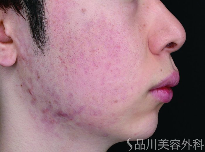 症例NO.72491のBEFORE写真