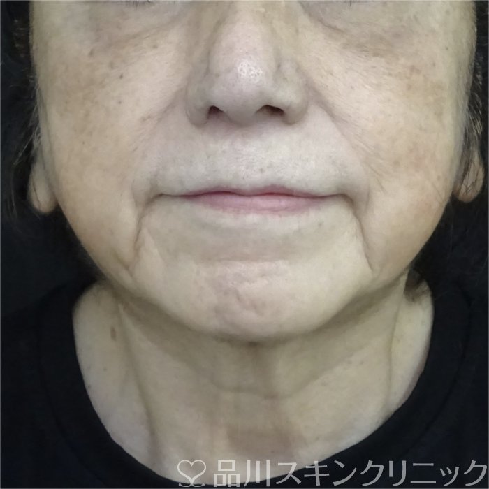 症例NO.72385のBEFORE写真