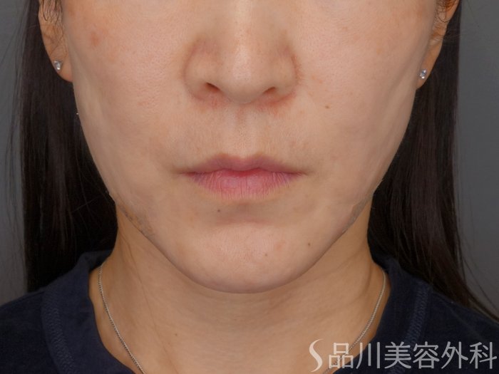 症例NO.72696のAFTER写真