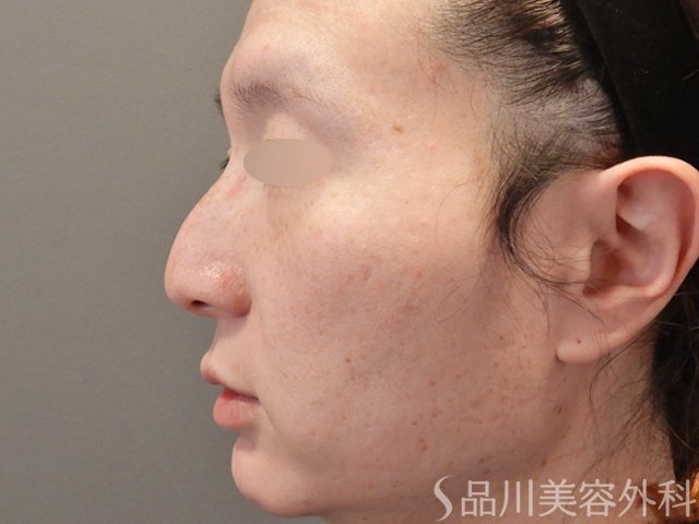 症例NO.74574のBEFORE写真