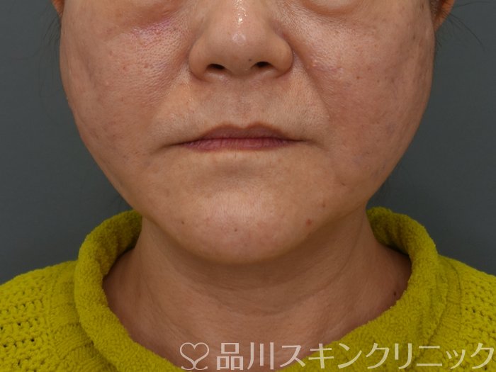 症例NO.74734のAFTER写真