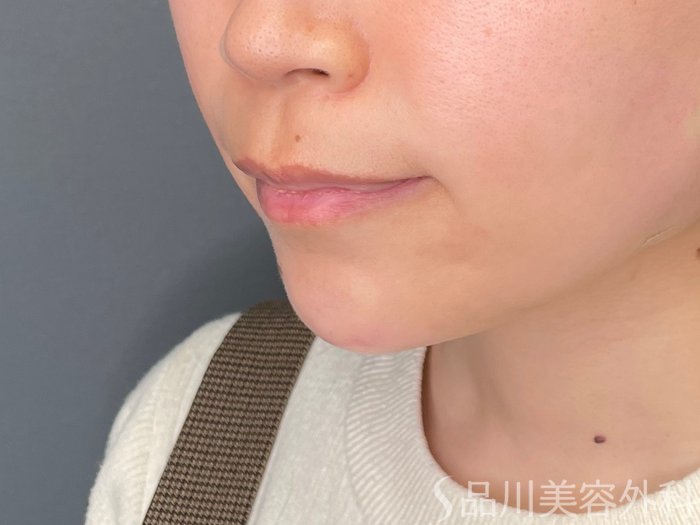 症例NO.65462のAFTER写真
