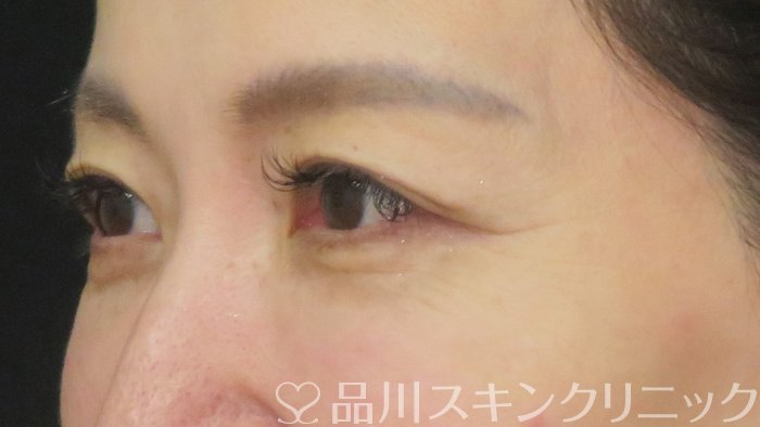 症例NO.70698のAFTER写真