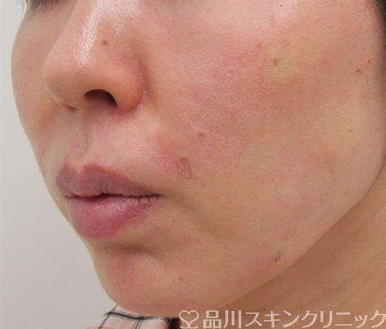 症例NO.30749のAFTER写真