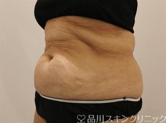 症例NO.46201のBEFORE写真