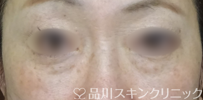 症例NO.69413のBEFORE写真