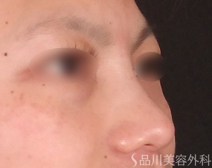 症例NO.70171のBEFORE写真