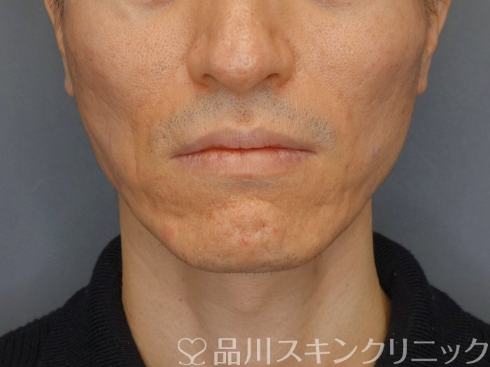 症例NO.72817のAFTER写真