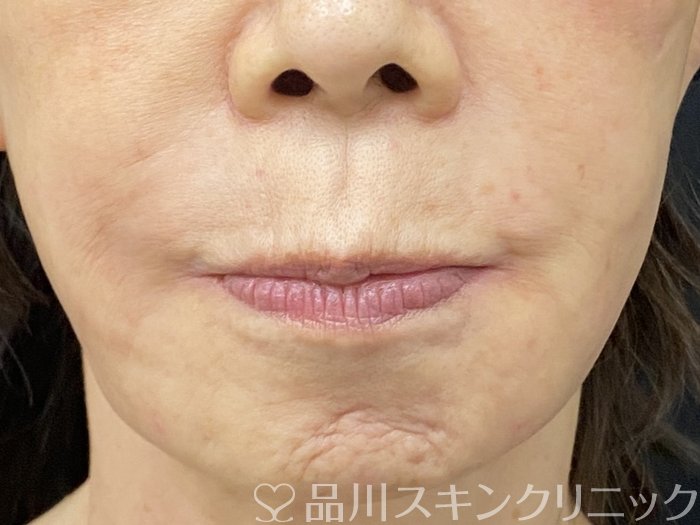 症例NO.74503のAFTER写真