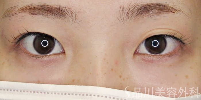 症例NO.71499のBEFORE写真