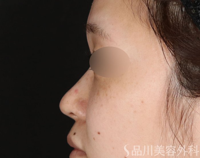 症例NO.72686のBEFORE写真