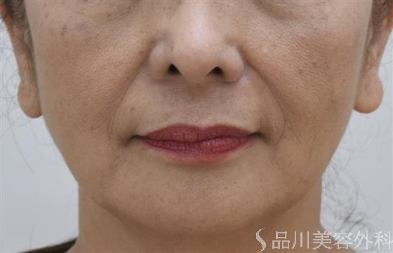 症例NO.44402のBEFORE写真