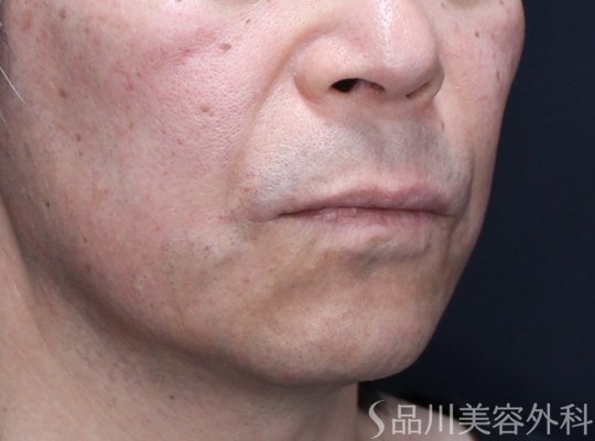 症例NO.71508のAFTER写真