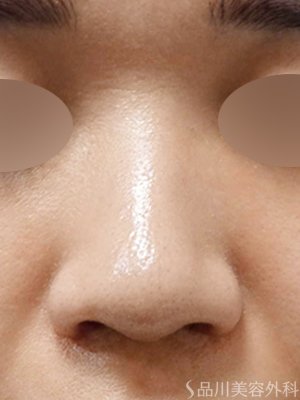 症例NO.69600のAFTER写真