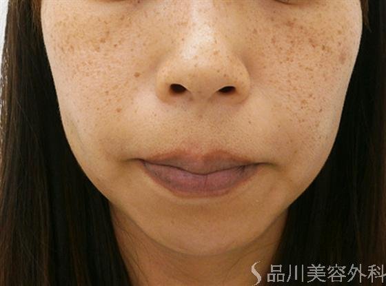 症例NO.14948のBEFORE写真