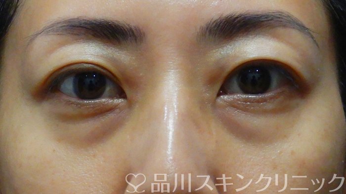 症例NO.67501のBEFORE写真