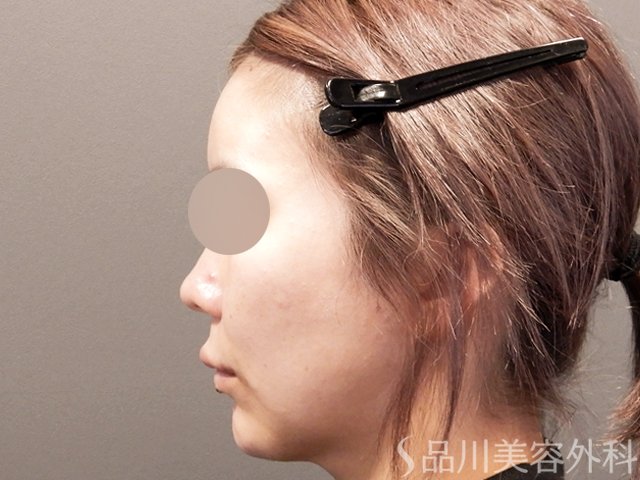 症例NO.67863のBEFORE写真