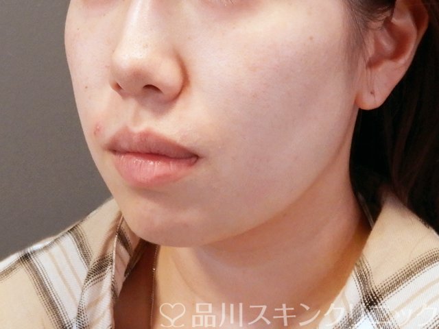 症例NO.67436のBEFORE写真