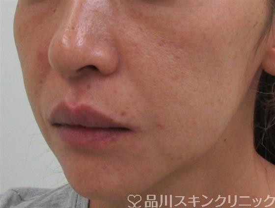 症例NO.32327のBEFORE写真