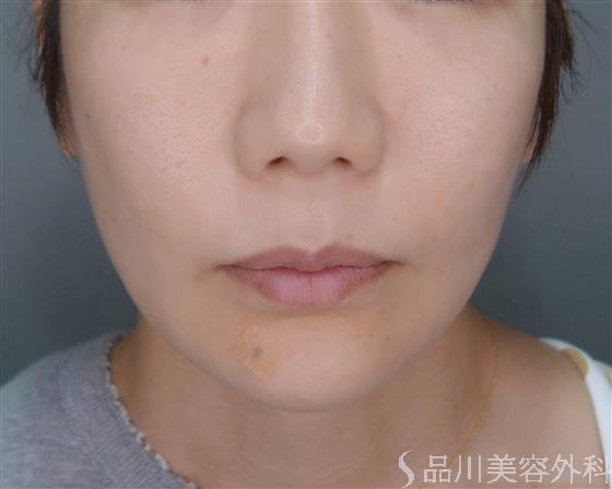 症例NO.51779のBEFORE写真