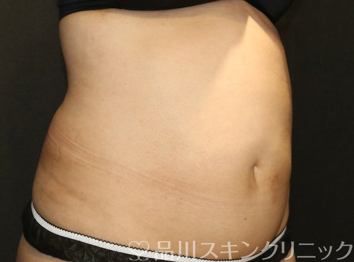 症例NO.72368のAFTER写真