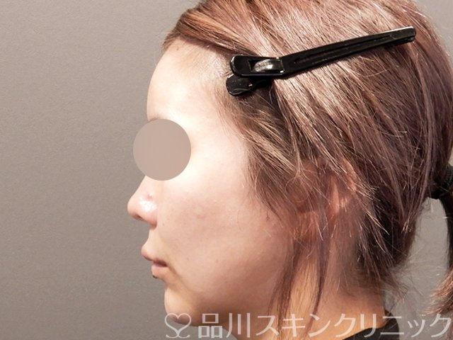 症例NO.67863のBEFORE写真