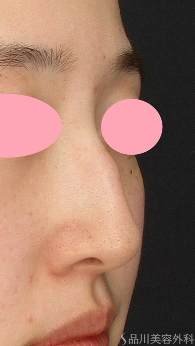 症例NO.74114のBEFORE写真