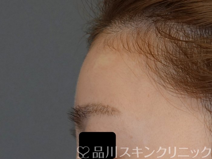 症例NO.72318のAFTER写真