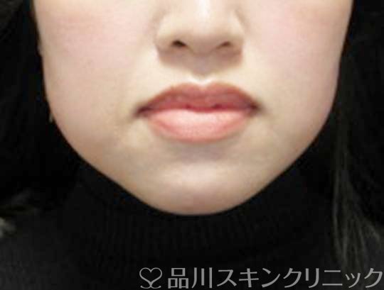 症例NO.72803のBEFORE写真