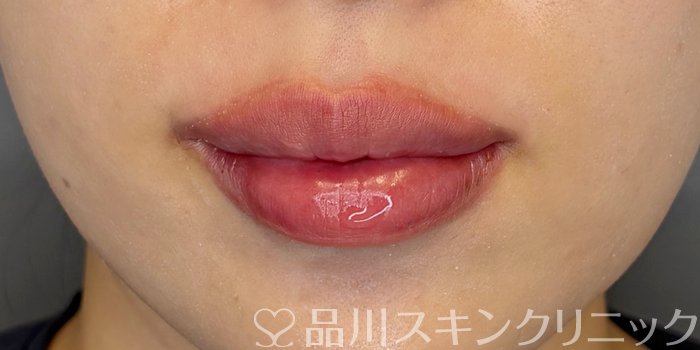 症例NO.71732のAFTER写真