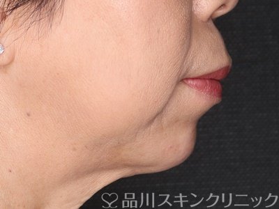 症例NO.74495のAFTER写真