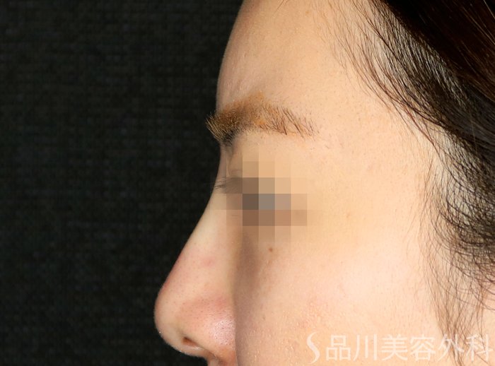 症例NO.64773のAFTER写真