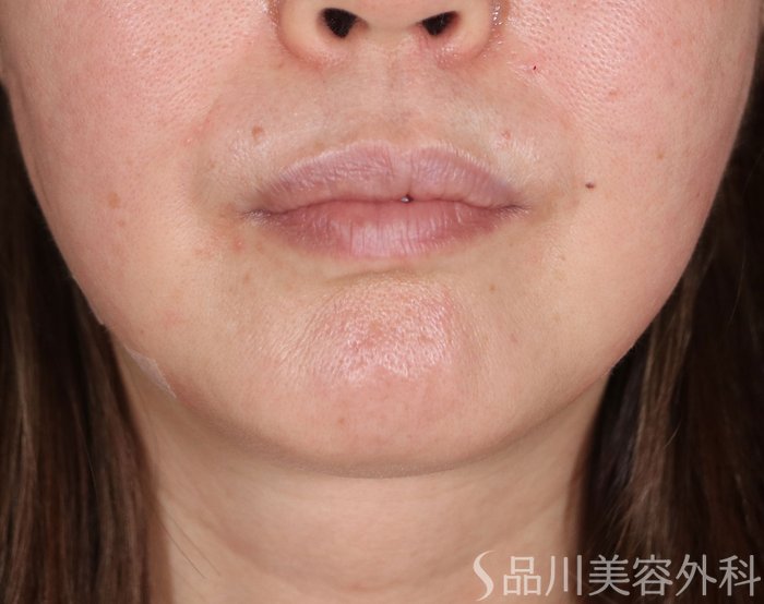 症例NO.72289のAFTER写真