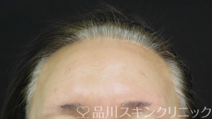 症例NO.74766のBEFORE写真