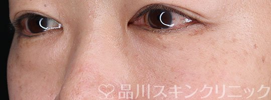 症例NO.65172のBEFORE写真