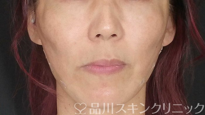 症例NO.72085のAFTER写真