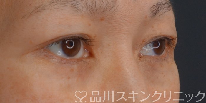 症例NO.74386のAFTER写真