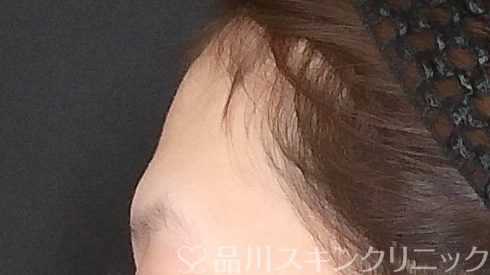 症例NO.72331のBEFORE写真