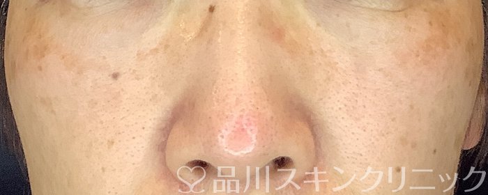症例NO.73917のBEFORE写真