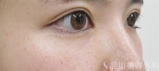 症例NO.35855のAFTER写真