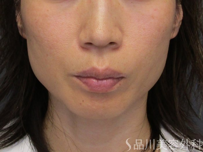 症例NO.75218のBEFORE写真