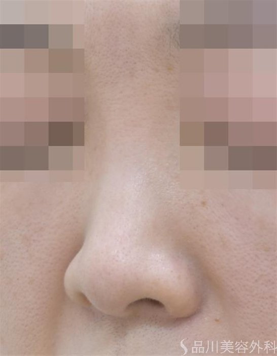 症例NO.46181のBEFORE写真