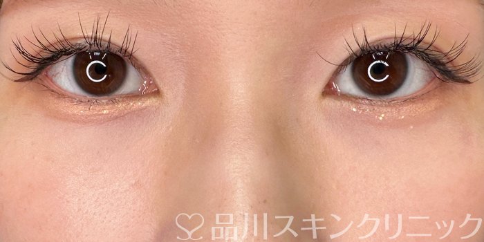 症例NO.65483のAFTER写真