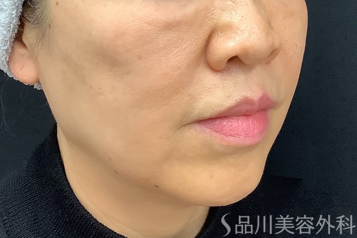 症例NO.73309のAFTER写真