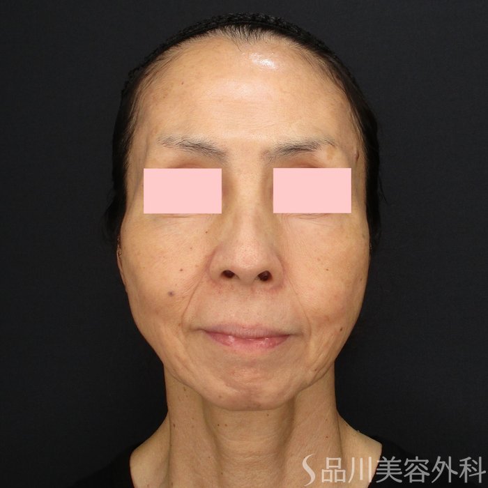 症例NO.69727のBEFORE写真