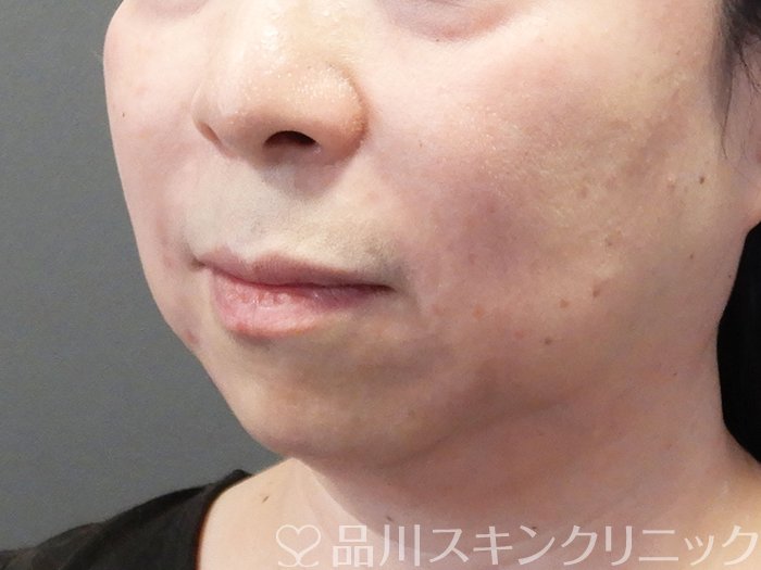 症例NO.72990のAFTER写真