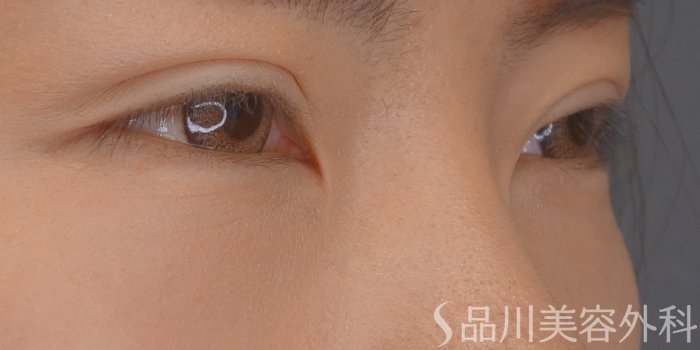 症例NO.68663のAFTER写真
