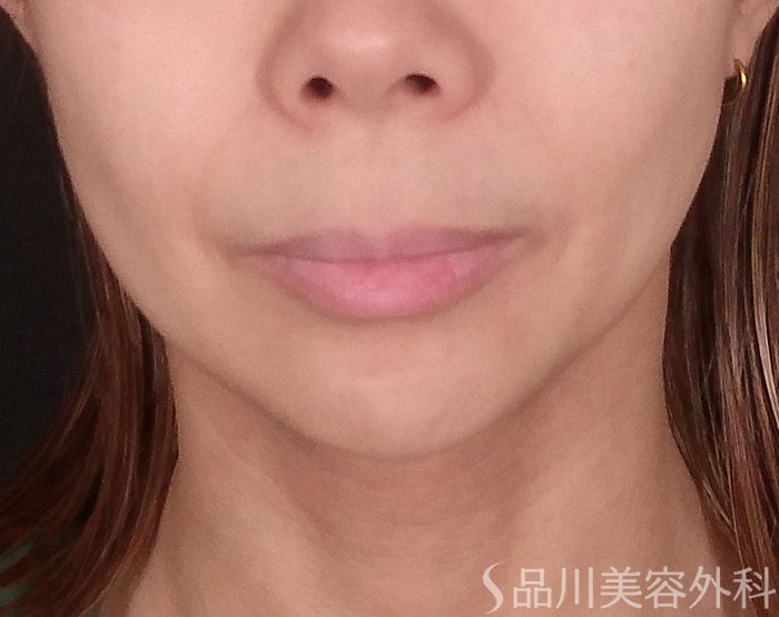 症例NO.69783のBEFORE写真