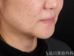 症例NO.72353のBEFORE写真